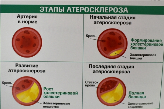 Контролируйте уровень холестерина