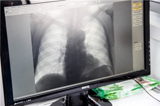 Медики Госпиталя спасли жизнь пациентке со 100% поражением лёгких!