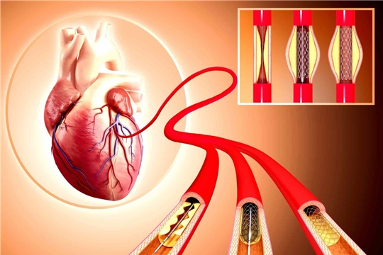 Объявлен аукцион на поставку стента для коронарных артерий