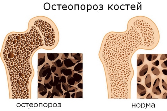 20 октября - Всемирный день борьбы с остеопорозом
