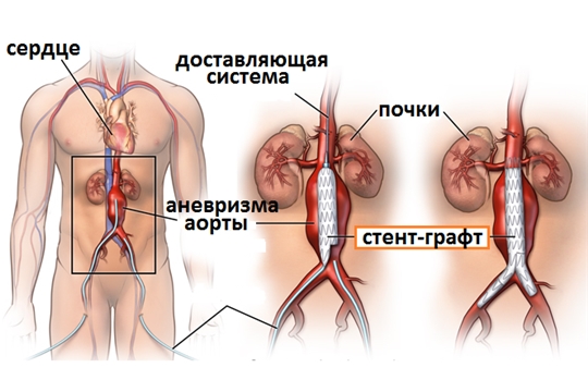 Впервые в Чувашии пациенту установлен стент-графт при аневризме брюшного отдела аорты