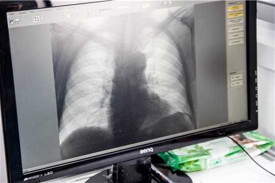 Мнение населения Чувашии по вопросу информированности о туберкулезе