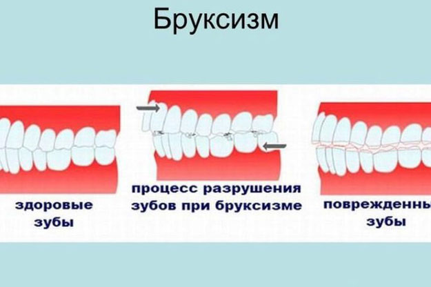 Бруксизм: 3 шага к успешному лечению