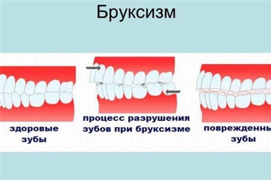 Если беспокоит бруксизм